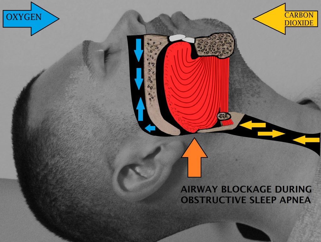 snoring-Airway-obstruction