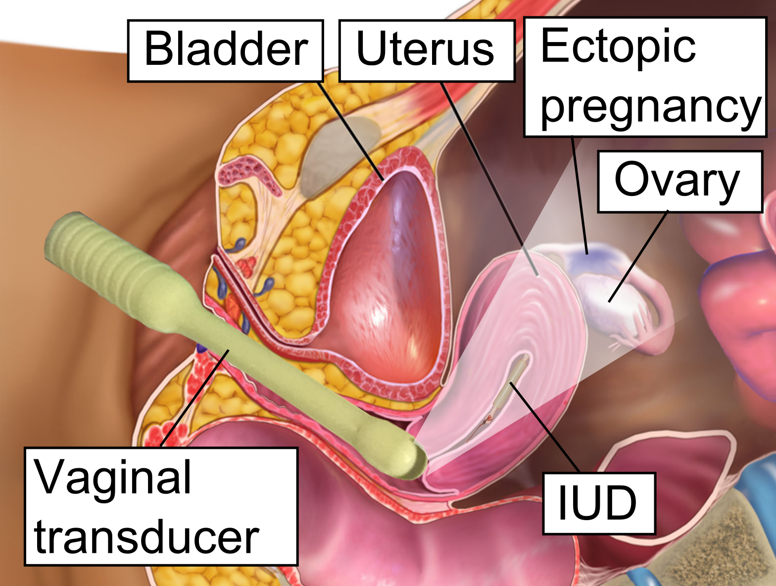 vaginal ultrasound in ectopic pregnancy